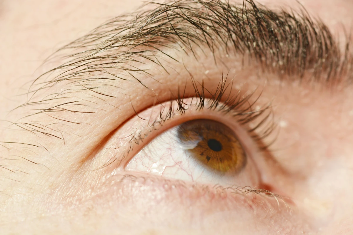 Retina dekolmanı yaz aylarında daha sık g&ouml;r&uuml;lebiliyor